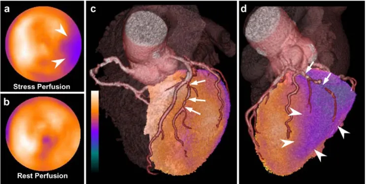 Figure 4 shows an overview of morphological and functional findings. Applying a cut-off for area stenoses of 50%, 17 (29.8%) of 57 stenotic main coronary arteries
