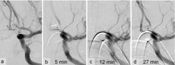 Fig. 1 Successful recanalisation using abciximab. After deployment of the second coil during endovascular treatment of an Acom aneurysm, the angiogram reveals thrombus formation in the adjacent A 2 segment of the left ACA (a)