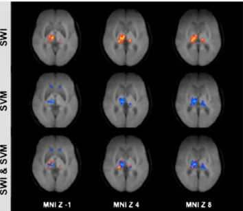 Fig. 1 Visual rating of SWI in PD. In accordance with a previous investigation [15], the SWI in substantia nigra (SN), red nucleus (RN) and dentate nucleus (DN) of the cerebellum and putamen was visually assessed and graded from 0-3