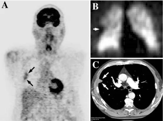 Fig. 1 A Coronal FDG PET in a 71-year-old male patient, known to have chronic thromboembolic lung disease, showing peripheral FDG accumulation in the upper lobe of the right lung (arrows;