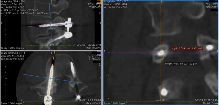 Fig. 1 Measurement of horizontal and vertical distance from the screw edge to the surface of the pedicle