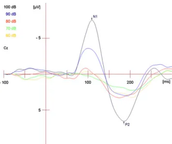 Fig. 2 Example of single subject auditory evoked potentials following stimulation with different sound pressure levels (60 to 100 dB)