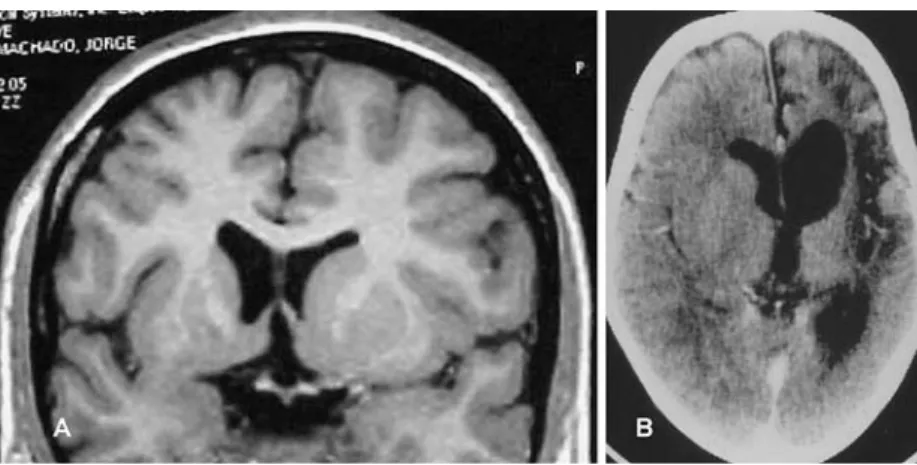 Fig. 3 Rasmussen’s chronic enceph- enceph-alitis a MRI, T1, coronal. Mild enlargement of the frontal horn, and smaller right hemisphere, at an early stage of the disease, b CT axial, with contrast