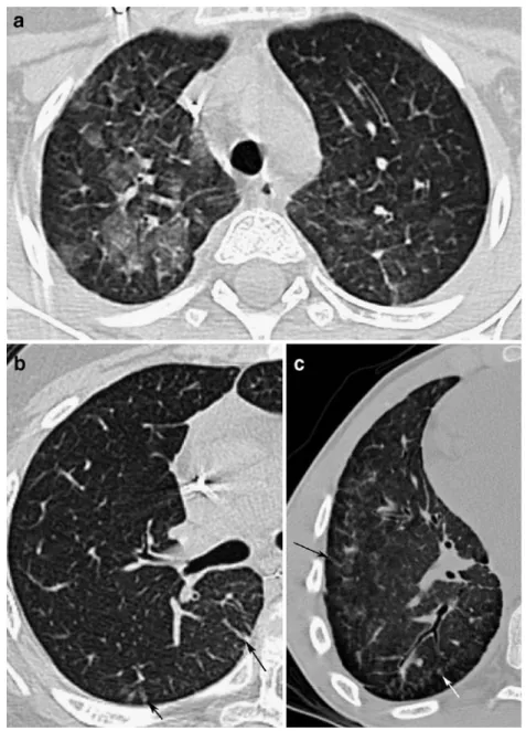 Fig. 5 Allogeneic BMT patients with mild cGVHD and good outcome. HRCT images show both extensive lung  in-volvement with ground-glass opacity (a) and interstitial thickening (b black arrows), or centrilobular nodules and micronodules (c white arrow)