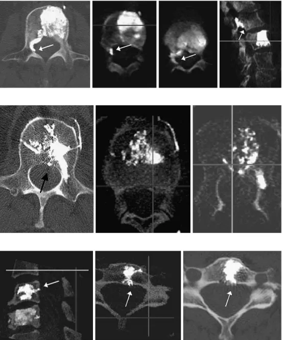 Fig. 2. A 71-year-old male with metastasis; treatment T11 to L1. CT left image. Leakage L1: paravertebral missed on RA initially; posterior leakage correctly recognized on RA (arrows).