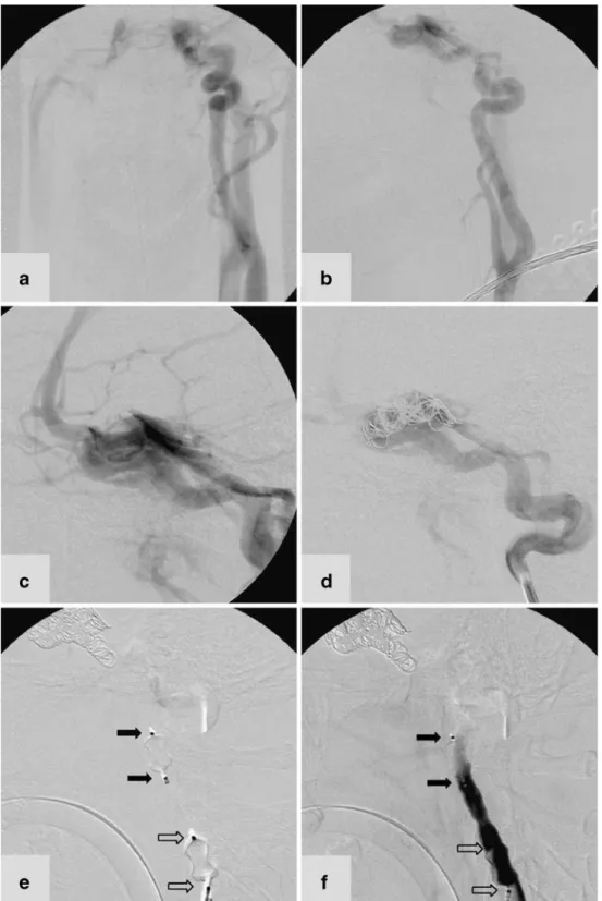 Fig. 2 DSA in an 18-year-old man with a left-sided CCF type A. a, b AP (a) and lateral (b) projections show that the left ICA terminates in the fistula and does not contribute to the  intra-cranial perfusion