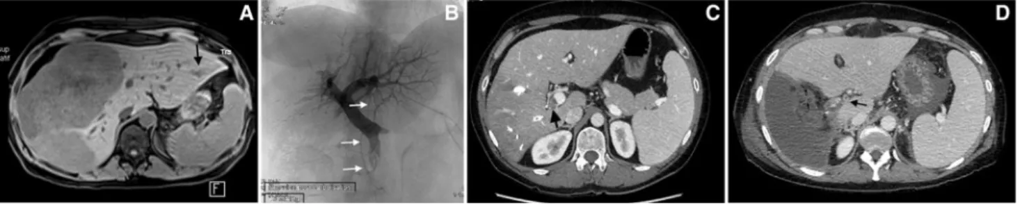 Fig. 2 A 45-year-old woman treated with six cycles of chemotherapy with oxaliplatin, 5-fluorouracil, and folinic acid
