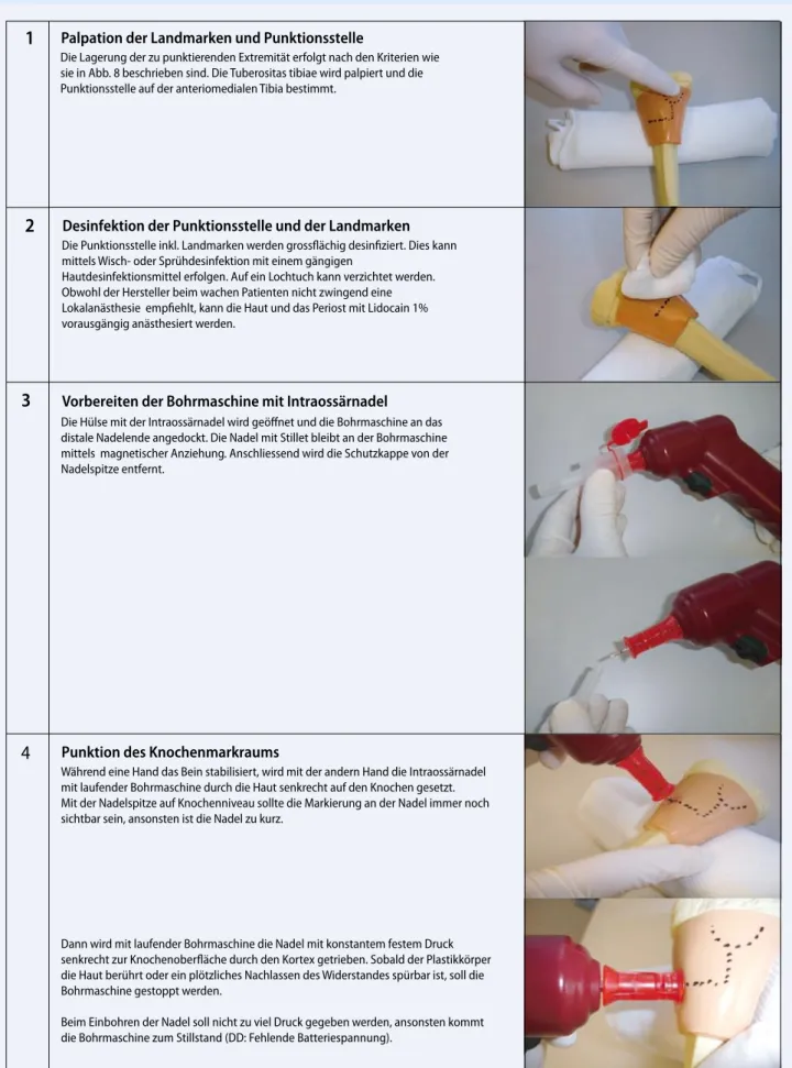 Abb. 10  8  Technik der intraossären Punktion und Infusion mit dem EZ-IO™-System an der proximalen Tibia