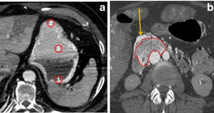 Fig. 3 Artefacts in the vascular system. a Perfusion defect of the pulmonary arteries (white arrow in the white circle)