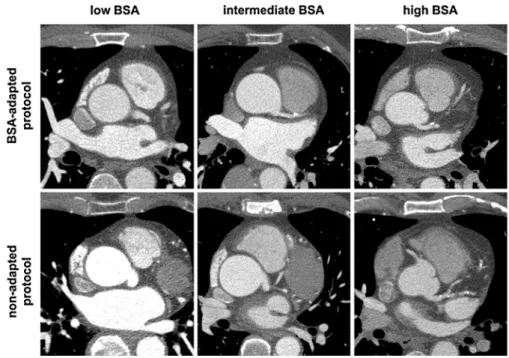 Fig. 2 CTCA images in patients with different body surface area. CTCA images of patients with low ( \ 1.8 m 2 ),  interme-diate (1.8–2.2 m 2 ) and high ( [ 2.2 m 2 ) body surface area (BSA)