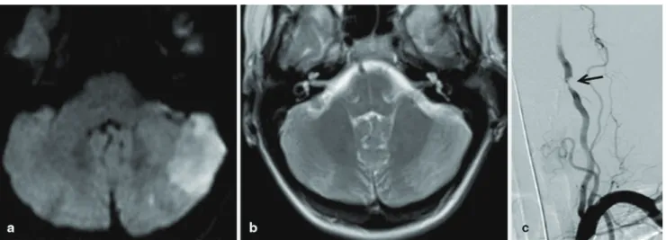 Fig. 1  a Hyperintense signal on diffusion-weighted imaging map reve- reve-als pICA territory cerebellar infarction on the left side