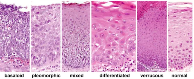 Fig. 2 Microphotographs of different features of dysplasia. a – cExamples of cellular features of the superficial compartment in verrucous dysplasia; d – f examples of cellular features of the suprabasal compartment in differentiated dysplasia, showing aty