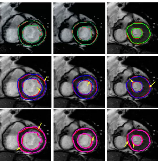 Table 1 Comparative performance of segmentation accuracy of cine MRI using four methods and two metrics (DM and HD)
