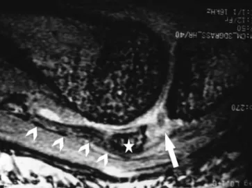 Fig. 6 MR image of a complete tear of the radial collateral liga- liga-ment of the second right MCP joint associated with a tear of the ulnar sagittal band
