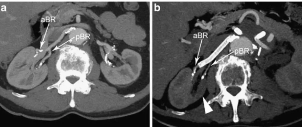 Fig. 16 A 77-year-old man who developed mesenteric ischaemia after visceral revascularisation