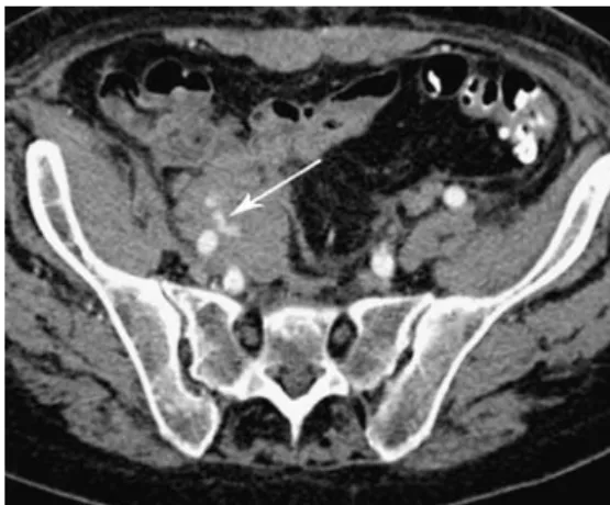 Fig. 14 Post-procedural ischaemia of the spleen in a 71-year-old man. MDCTA reveals a focal splenic infarction (arrow)