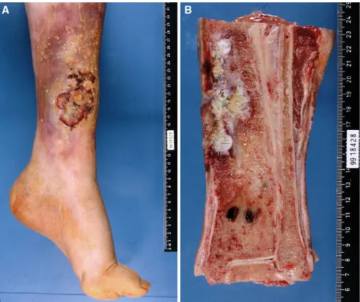 Fig. 1 Patient N°5 a Ulcerated  lesion of the distal left leg  showing irregular contours  and slightly elevated edges