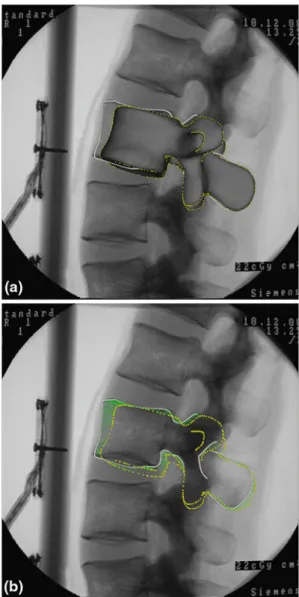 Figure 5a shows the mean mode of the complete-PDM initial- initial-ized with respect to the input image using the landmark-based scaled rigid registration, and the apparent contours extracted from the mean model