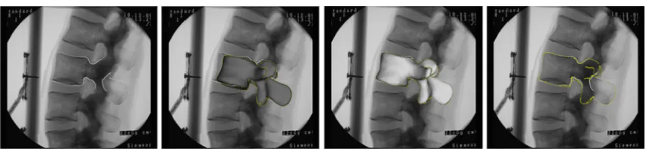 Fig. 7 Different stages of the reconstruction process. Left the smoothed contours; left middle the landmark-based initialization of the mean model (grey) of the PDM; right middle the reconstructed model