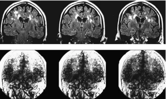 Fig. 3 The MRI (coronal FLAIR) with a watershed lesion in the frontal lobe on the left side (white arrow) and  paren-chymography with a ﬁlling defect on the left side  (asym-metrical)