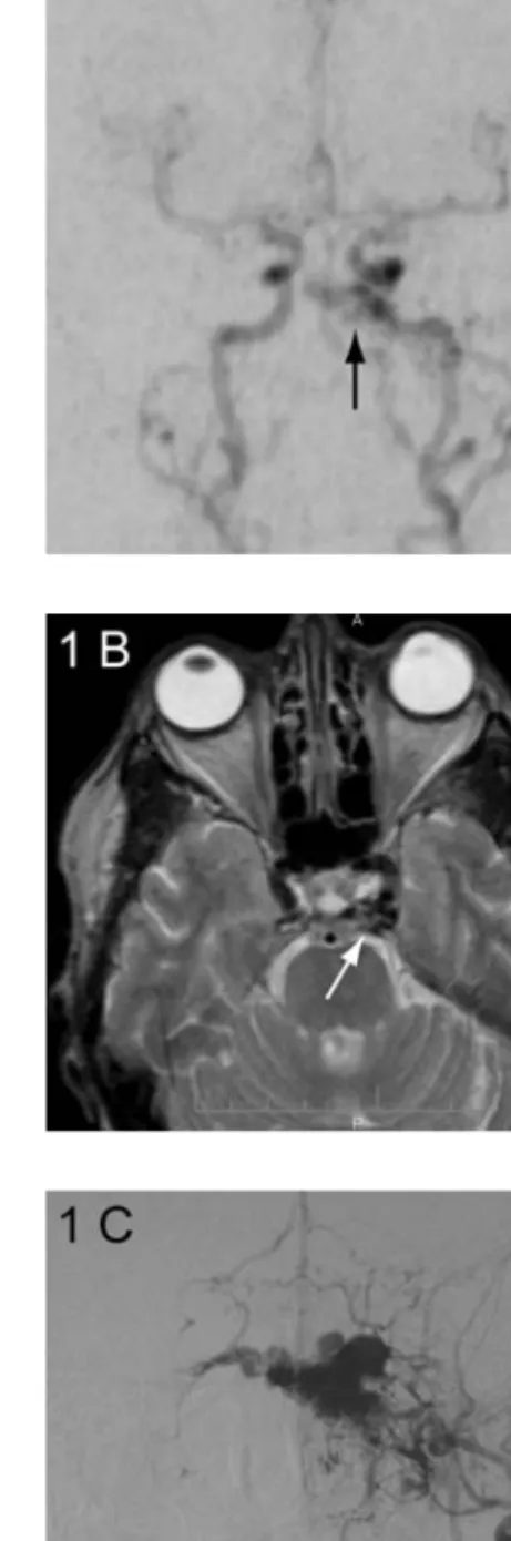 Fig. 1 A: MR DSA image during the early arterial phase. Note the early flow into the cavernous sinus (arrow) from a prominent artery (arrowhead) on the left side