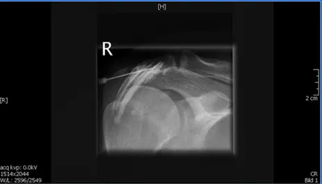 Fig. 1 Imaging-guided injection attempting to target the subacromial bursa. Contrast medium injection demonstrates that the needle is not in the bursa