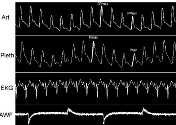 Fig. 1 Simultaneous recording of systemic arterial pressure (Art), plethysmographic “pulse” (Pleth), EKG and airway flow (AWF) curves in one patient with large ∆ PP and ∆ P PLET 