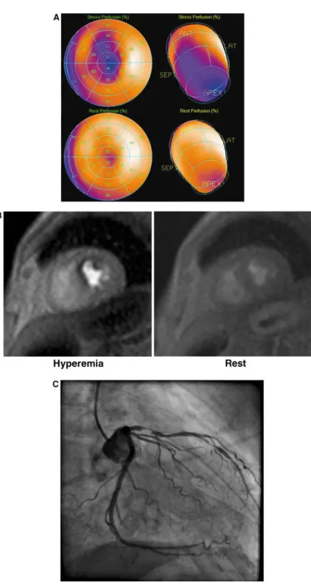 Figure 1. A Polar maps and three-dimensional (3D) 201 TI-SPECT images with a perfusion defect in the antero-septo-apical region during dipyridamole stress test that widely resolves on the resting perfusion SPECT images (SSS = 20; SRS = 2; SDS = 18)