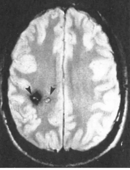 Abb. 1  8  Magnetresonanztomographie   eines Kavernomträgers mit multiplen   Kavernomen (mit Genehmigung aus [41])