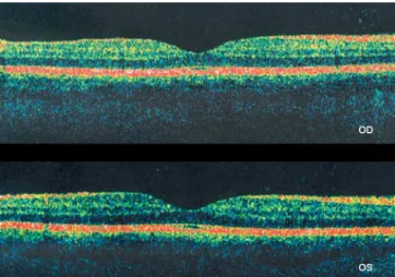 Fig. 2 Optical coherence tomography revealed mild subclinical ME (226 mm OD, 238 mm OS), with the visual acuity still being 20/