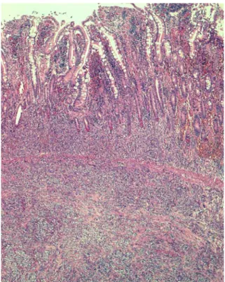 Fig. 3 Strong reactivity of clear cell sarcoma cells for S-100 protein