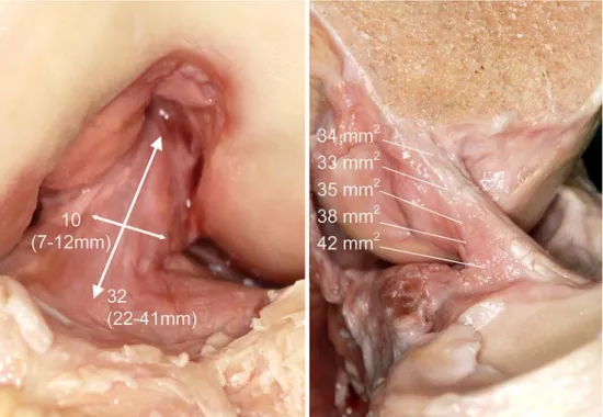 Fig. 1 Front view of a left knee showing the ACL in the femoral intercondylar notch. The mean length is 32 mm (range, 22–41 mm) (left picture) and the mean width is 10 mm (range, 7–12 mm)
