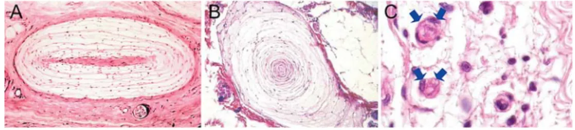 Fig. 6 Ruﬃni receptors (a) and Vater–Pacini receptors (b). These mechanoreceptors have proprioceptive functions and provide the aﬀerent arc for postural changes of the knee through deformation within the ligament