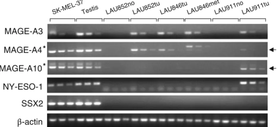 Table 1 CT gene expression frequencies in colon cancer primary tumors