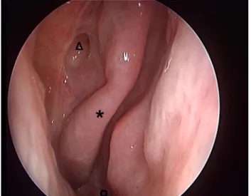 Fig. 2 Endoscopy of the right nasal cavity (2 years after fronto-sphe- fronto-sphe-no-ethmoidectomy with removal of the middle turbinate) showing the right sphenoethmoid recess with the sphenoid sinus (open triangle) and the superior turbinate (asterisk)