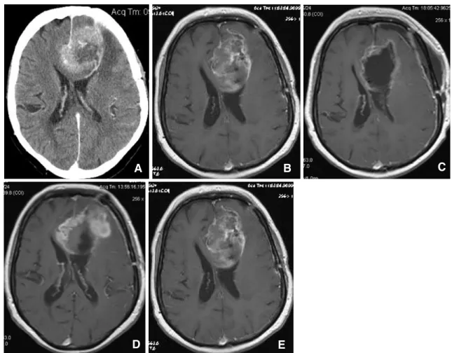 Fig. 3 Patient 1, left frontal GBM, CT and T1-weighted contrast- contrast-enhanced MR imaging