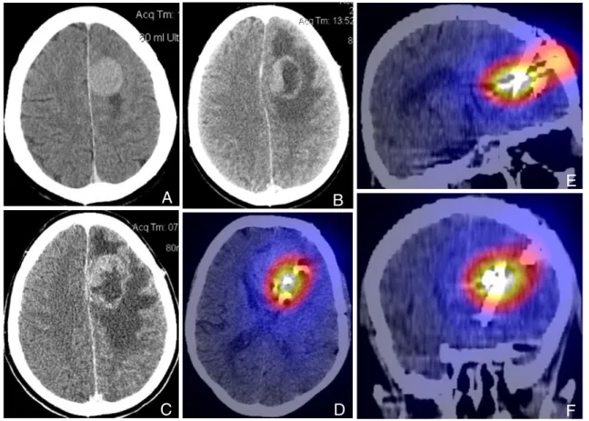 Fig. 4 Patient 2, left frontal GBM, contrast-enhanced CT imaging (a – c) and SPECT/CT (d – f)