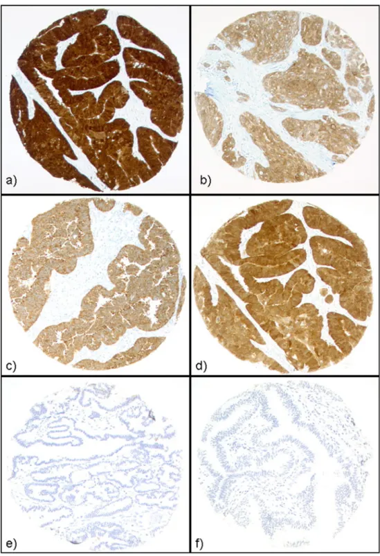 Fig. 1 CT antigen expression in ovarian neoplasms. Strong and homogeneous staining of NY-ESO-1 (a), GAGE (b), MAGE-A4 (c) and MAGE-C1/