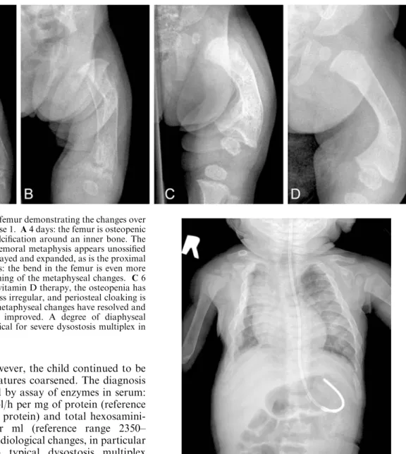 Fig. 5 PA ﬁlm of the chest (case 1) at 4 months shows the greatly expanded ribs, typical of ML II