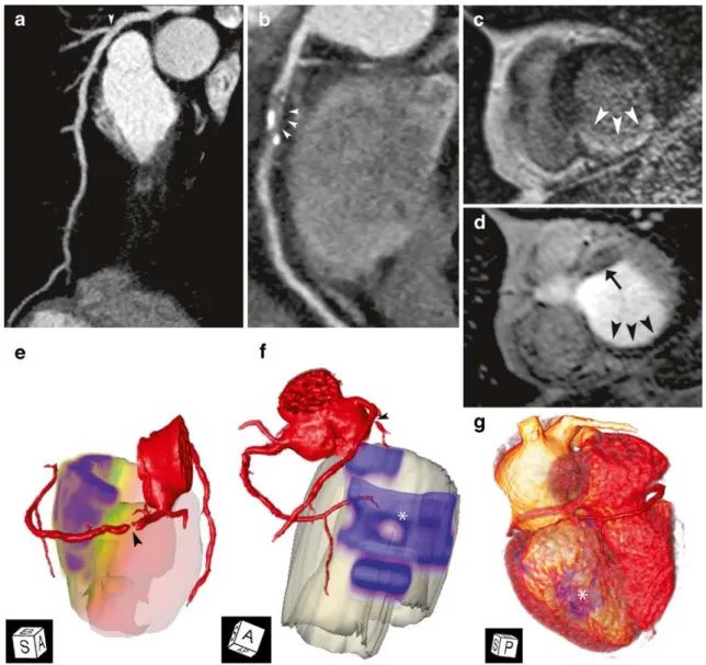 Fig. 1 A 52-year-old male patient with CAD. Prospectively ECG- ECG-triggered CTCA shows stenosis of the first diagonal branch (D1) ( arrowhead in a) and occlusion of the proximal right coronary artery (RCA, arrowheads in b)