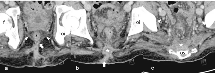 Fig. 1 The patients' CT scan at admission, showing a large subcuta- subcuta-neous abscess (star) on the flank at the level of the fourth lumbar vertebral body, communicating with the iliopsoas muscle, the  para-spinal muscles, and the epidural space (arrow