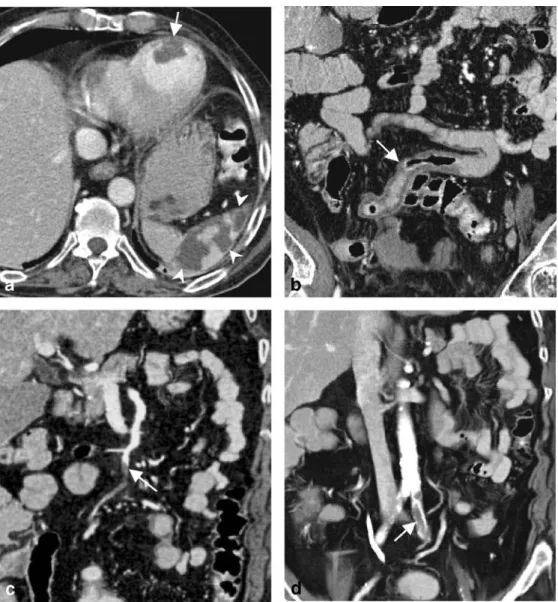 Fig. 2 A 59-year-old man with known cardiac aneurysm after myocardial infarction 1 year previously and sudden  abdomi-nal and left lower extremity pain