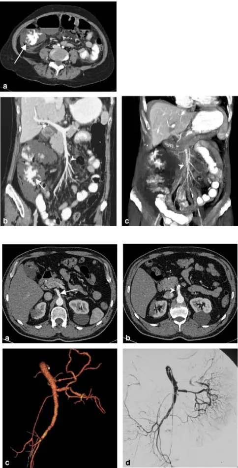 Fig. 4 A 61-year-old woman with elevated liver enzymes and abdominal pain after aortic and mitral valve replacement and known cardiac arrhythmia.