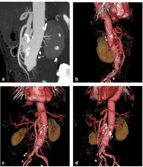 Fig. 8 A 65-year-old female with ruptured aortic abdominal aneurysm. The patient received an aortic graft with reinsertion of the visceral vasculature.
