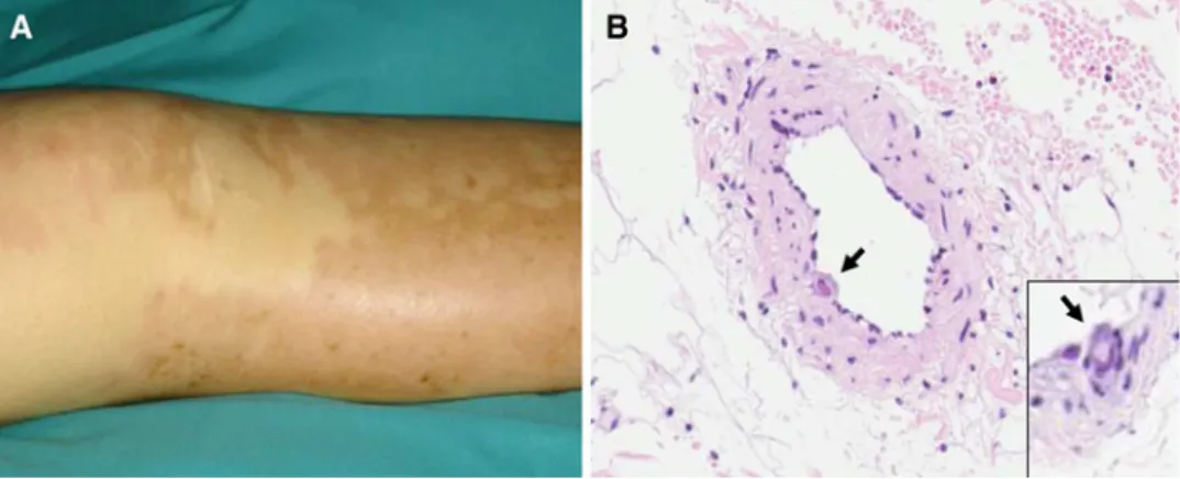 Fig. 1 a Erythematous, macu- macu-lar rash, sharply demarcated within hypopigmented areas.