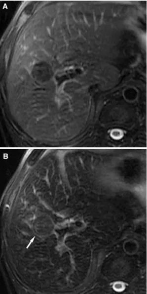 Fig. 4. Cirrhotic liver in a 46-year-old male with an HCC nodule in liver segment 5, 30 days after the second TACE session