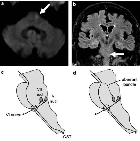 Fig. 1 Axial diffusion- diffusion-weighted (a) and coronal FLAIR brainstem MRI (b) showing an ischemic lesion in the left caudal ventral paramedian pons (arrows).