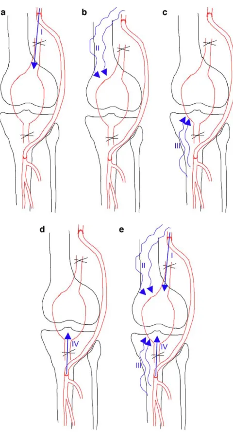 Fig. 3 Residual blood flow in surgically excluded PAAs.