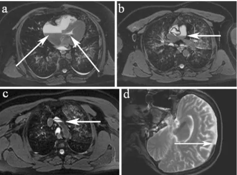 Fig. 1 a–d Sedimentation within the vascular system visualized as typical fluid levels in axial T2-weighted MR images [TE 96 ms, TR 4,000 ms]: a right atrium and left ventricle and b pulmonary artery, c aortic arch, and d in a cranial sagittal image within
