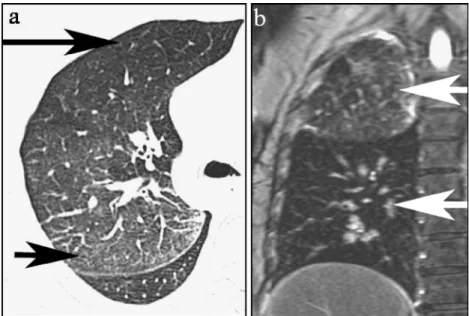 Fig. 7 a Internal livores of the liver at beginning putrefaction in an axial T2-weigted MR image (TE 96 ms, TR 4,000 ms);